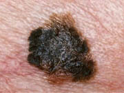 crni rak kože melanom